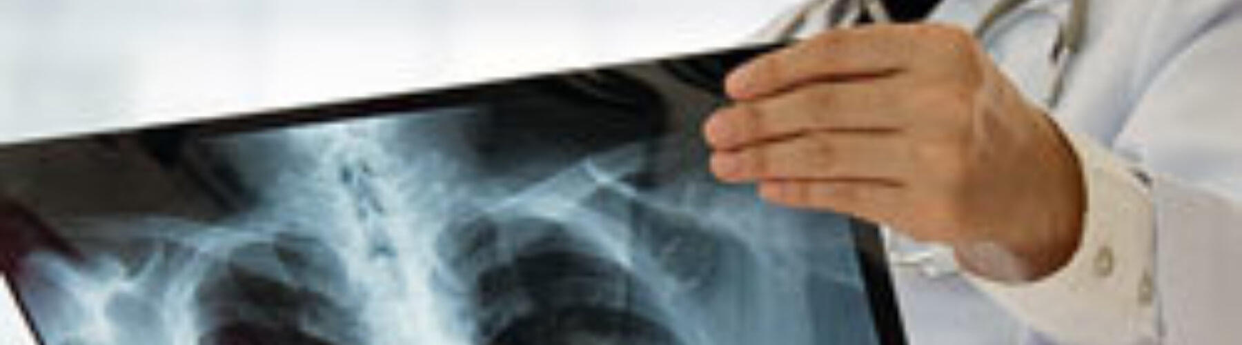 Doctor examining x-ray of mesothelioma patient