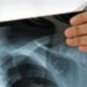 Doctor examining x-ray of mesothelioma patient